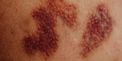 마사지 받고 멍이 들었다면 — 정상 반응과 병원에 가야 할 때
